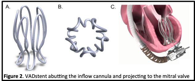 Illustration of a VADstent abutting the inflow cannula and projecting to the mitral valve