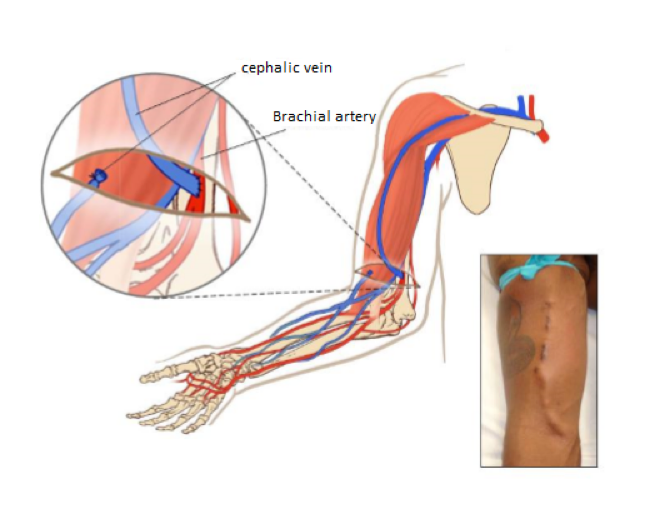 Illustration of a Brachial artery and a cephalic vein in the arm